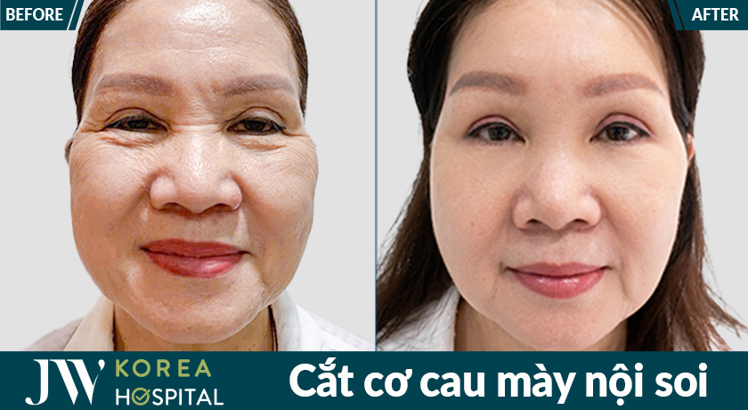 Khách hàng sở hữu gương mặt tươi tắn hơn sau khi cắt cơ cau mày nội soi tại Bệnh viện JW