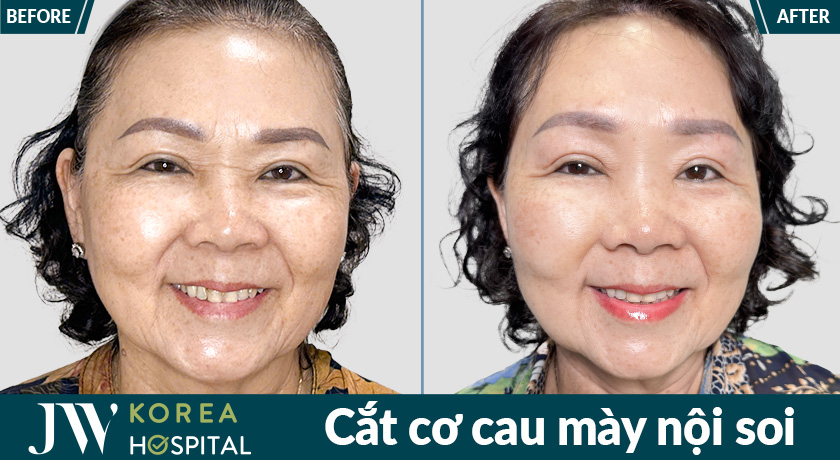 Hình ảnh trước và sau cắt cơ cau mày nội soi tại bệnh viện JW