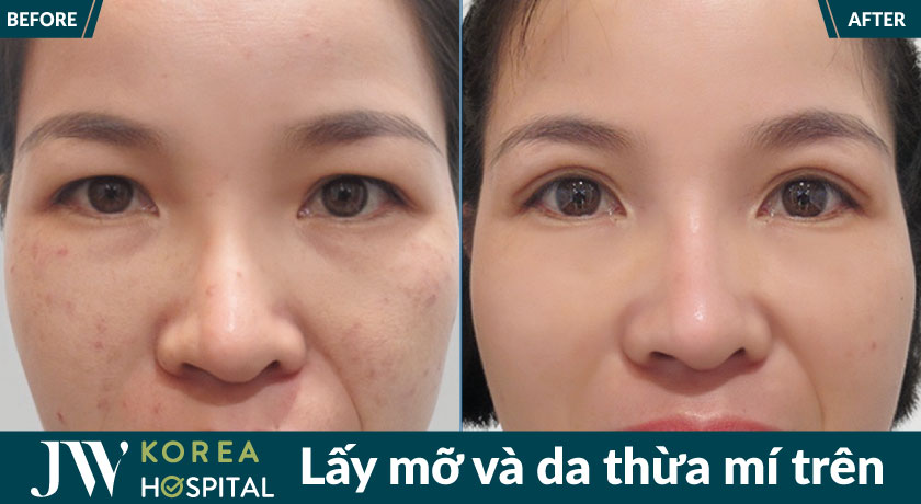 Hình ảnh khách hàng trước và sau khi lấy mỡ da thừa mí trên tại bệnh viện JW