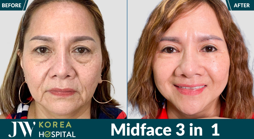 Xóa nếp nhăn, trẻ 10 tuổi với Midface 3 in 1 tại bệnh viện JW