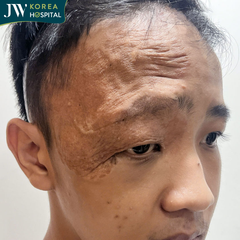 Vùng mắt phải của nam sinh 16 tuổi bị da dư và mô sẹo che phủ do di chứng u máu bẩm sinh