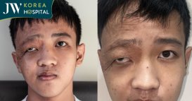Nam sinh 16 tuổi mắc u máu bấm sinh, bị gọi là cụ già tìm đến bệnh viện JW điều trị