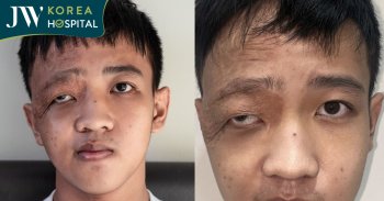 Cậu bé 16 tuổi bị gọi là cụ già vì di chứng khối u máu nuốt chửng mắt
