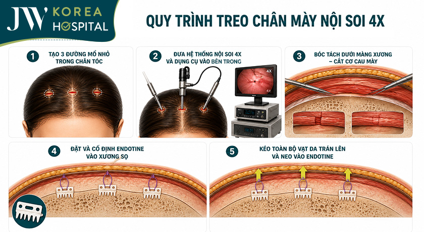 Quy trình treo chân mày nội soi 4X