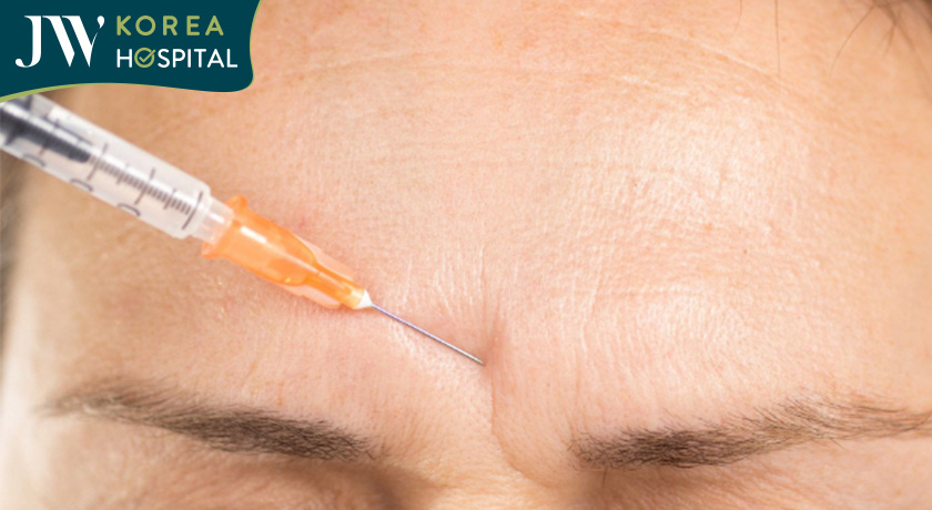 Tiêm filler để xóa cơ cau mày, có hiệu quả nhưng không kéo dài lâu