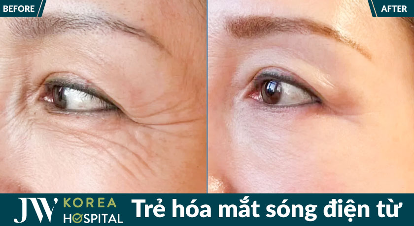 99% khách hàng hài lòng sau 1 liệu trình trẻ hóa mắt bằng sóng điện từ RF tại bệnh viện JW
