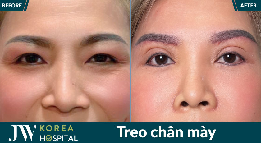Hình ảnh trước và sau treo chân mày tại bệnh viện JW