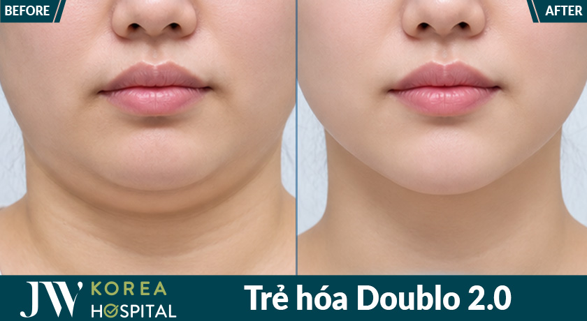 Doublo 2.0 hỗ trợ cải thiện nọng cằm và làm gương mặt trông thon gọn hơn