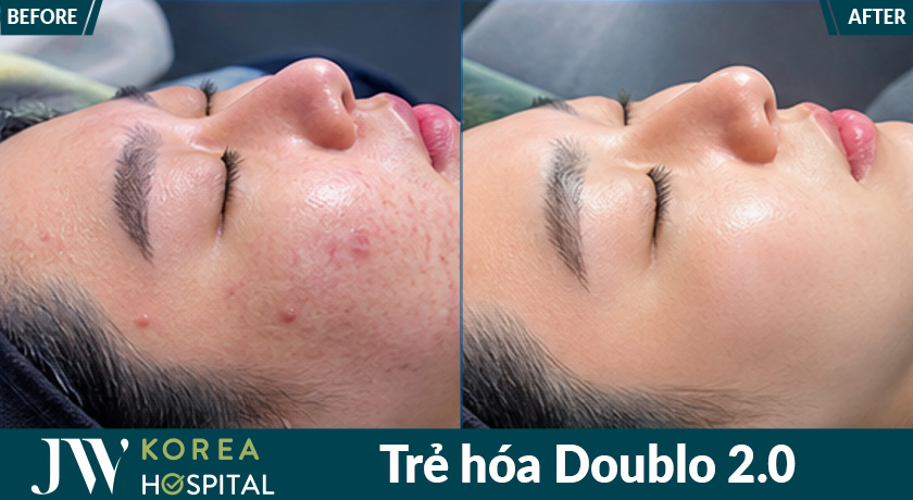 Trẻ hóa đa tầng với New Doublo 2.0 giúp hướng đến gương mặt săn chắc, đường nét rõ và làn da mịn hơn