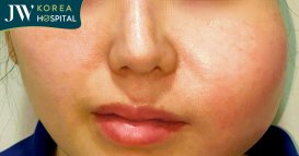 Má áp xe nghiêm trọng sau 5 năm tiêm chất làm đầy ở cơ sở thẩm mỹ chui
