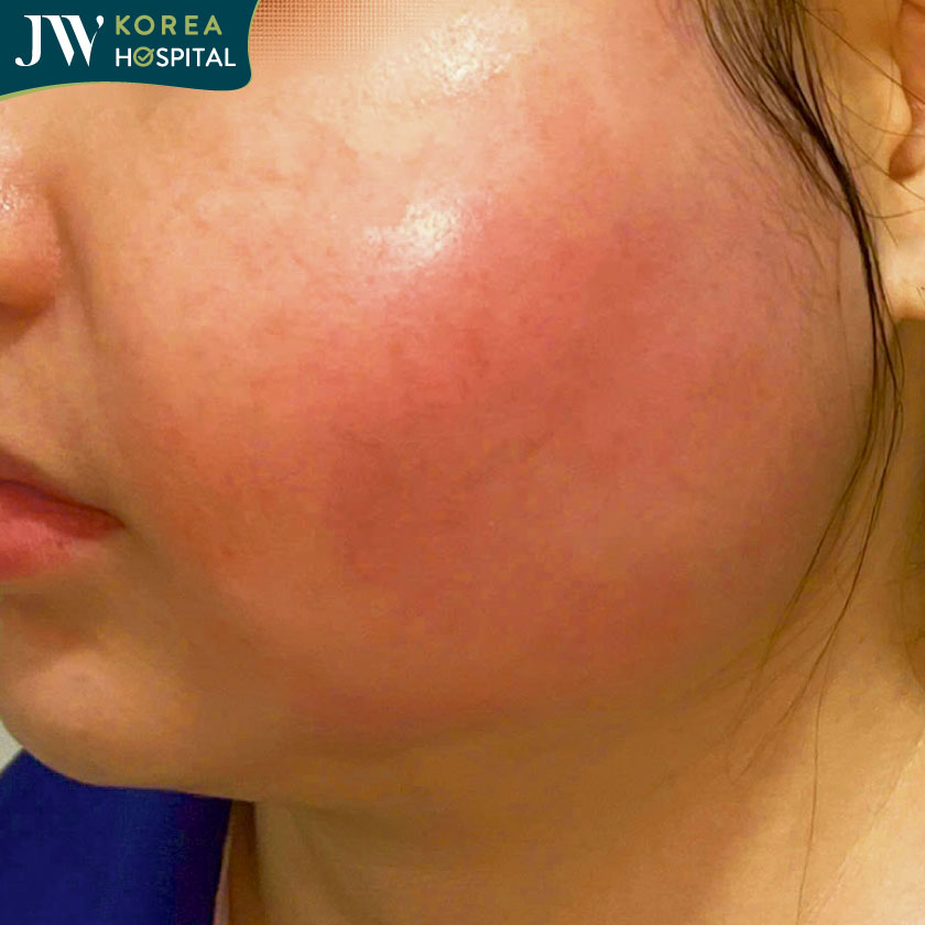Người phụ nữ 28 tuổi biến chứng sau tiêm filler gây áp xe vùng má