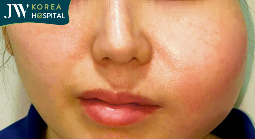 Bệnh nhân 28 tuổi bị áp xe má sau 5 năm tiêm filler
