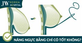 Nâng ngực bằng chỉ có tốt không?