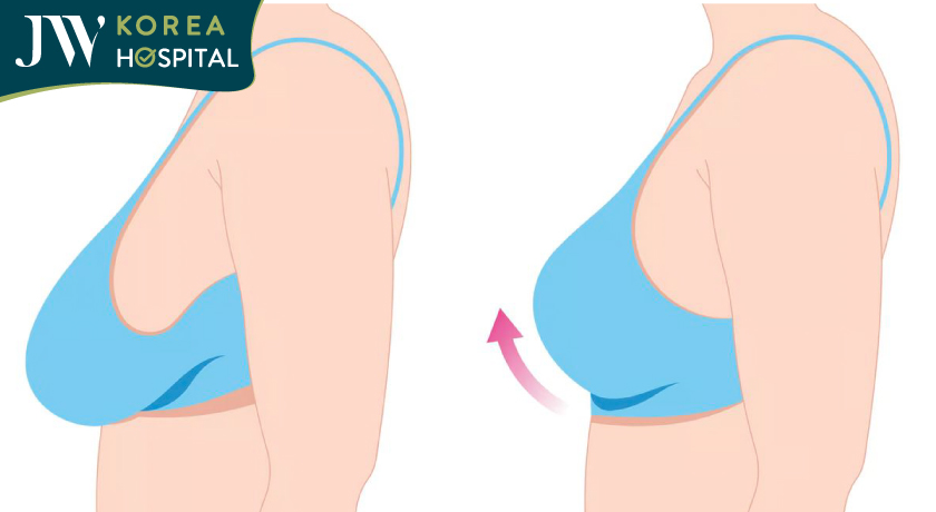 Nâng ngực bằng chỉ cho ngực chảy xệ