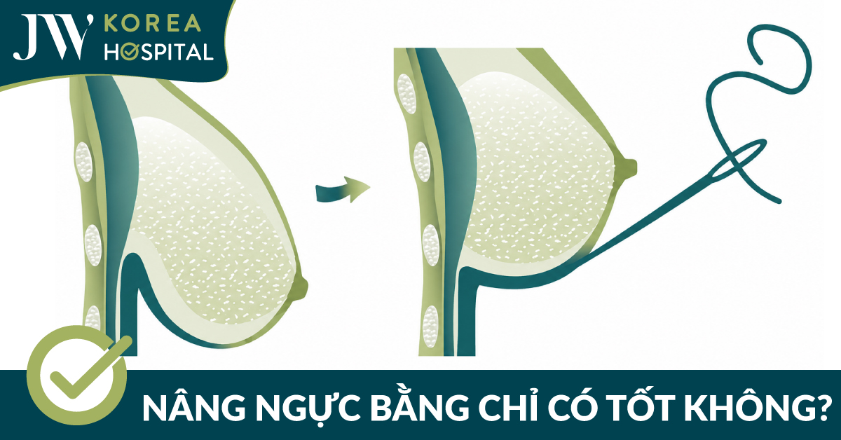 Nâng ngực bằng chỉ: Bóc trần sự thật về xu hướng thẩm mỹ hot nhất 2026