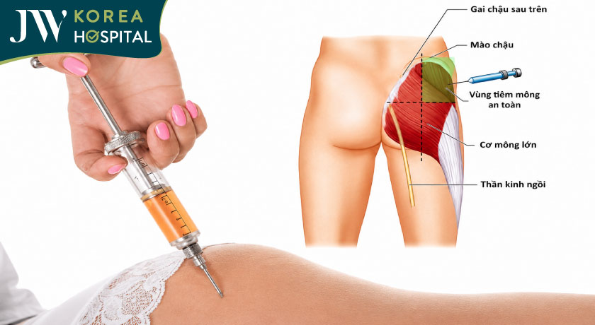 Có nên tiêm filler mông không? Ưu nhược điểm của phương pháp này là gì?