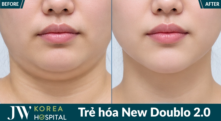 công nghệ trẻ hóa không phẫu thuật New Doublo 2.0 tại bệnh viện JW
