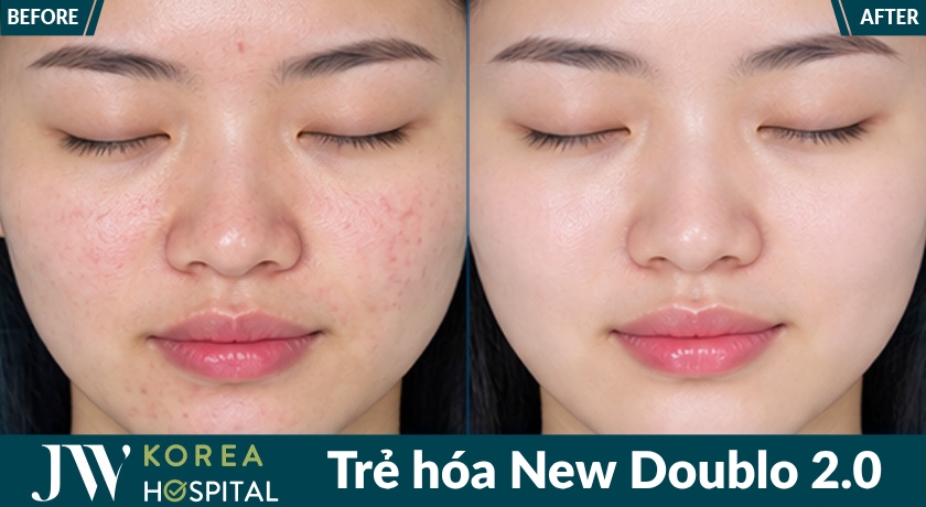 New Doublo 2.0 là công nghệ trẻ hóa không phẫu thuật tại bệnh viện JW