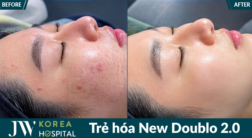 công nghệ trẻ hóa không phẫu thuật phù hợp với phụ nữ sau tuổi 30 da chảy xệ nhẹ