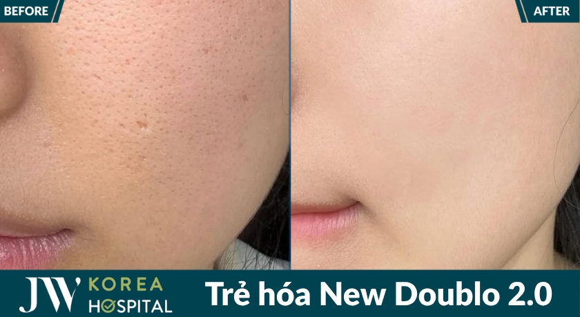 Công nghệ trẻ hóa NEw Doublo 2.0 giúp hỗ trợ nâng cơ, săn chắc da không phẫu thuật