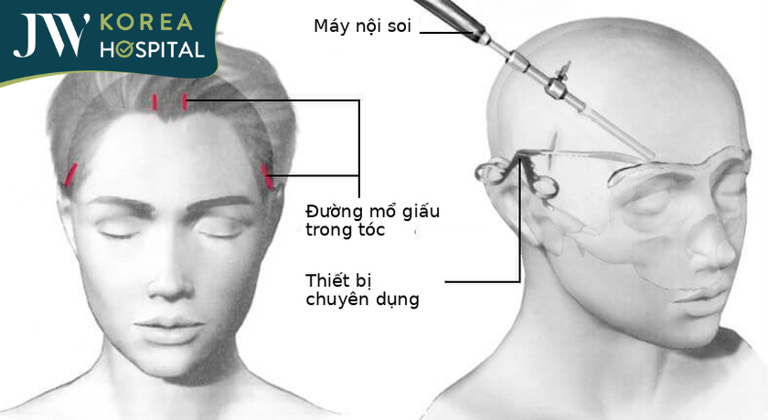 Treo chân mày nội soi 4X sẹo vô hình tại JW