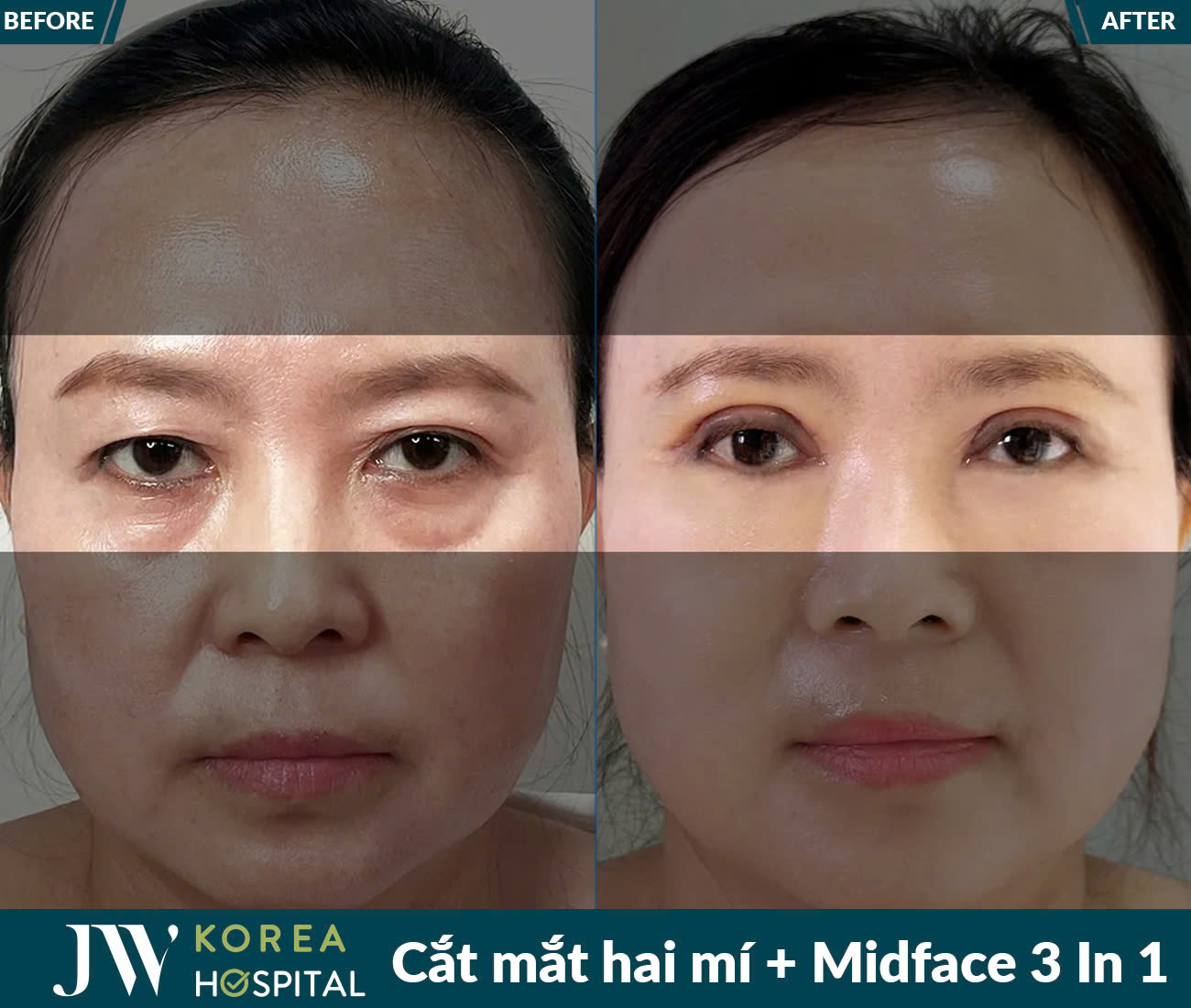 Cắt mắt/Bấm mí