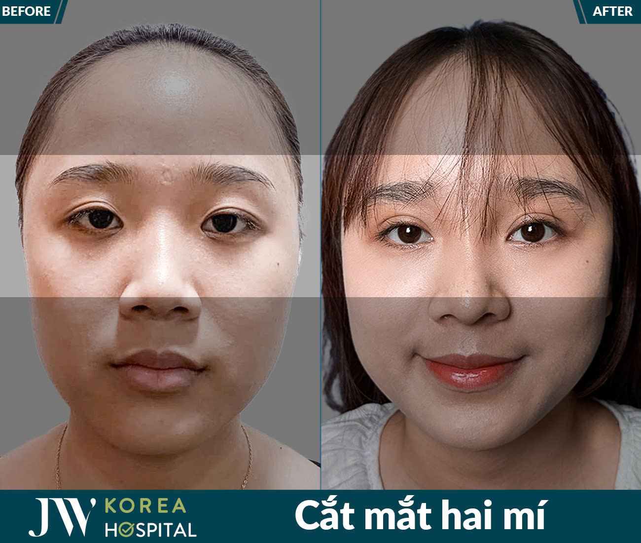 Cắt mắt/Bấm mí