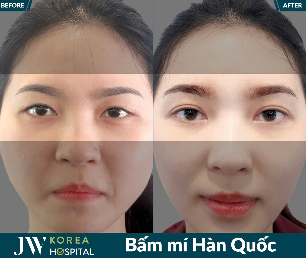 Cắt mắt/Bấm mí