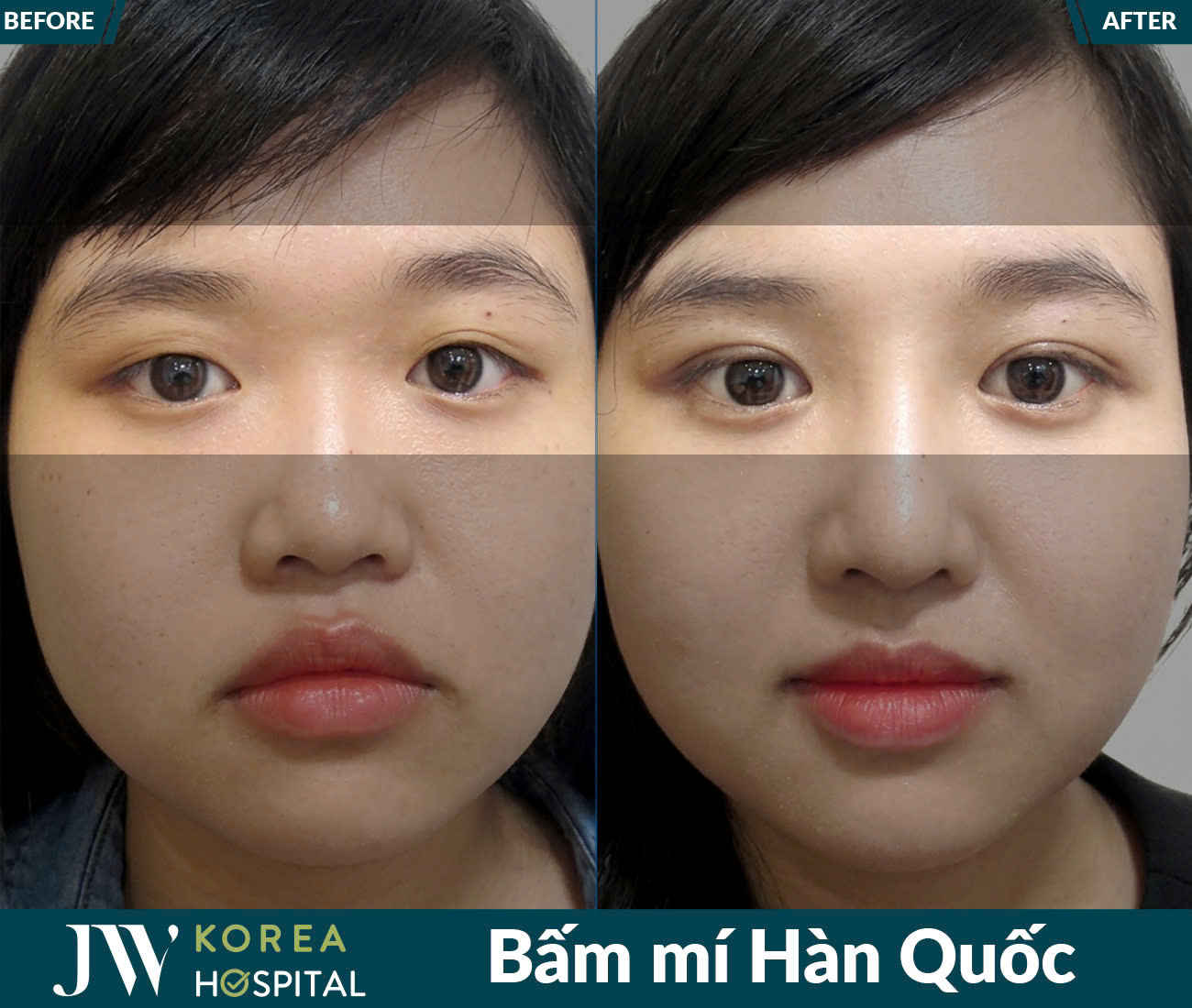 Cắt mắt/Bấm mí