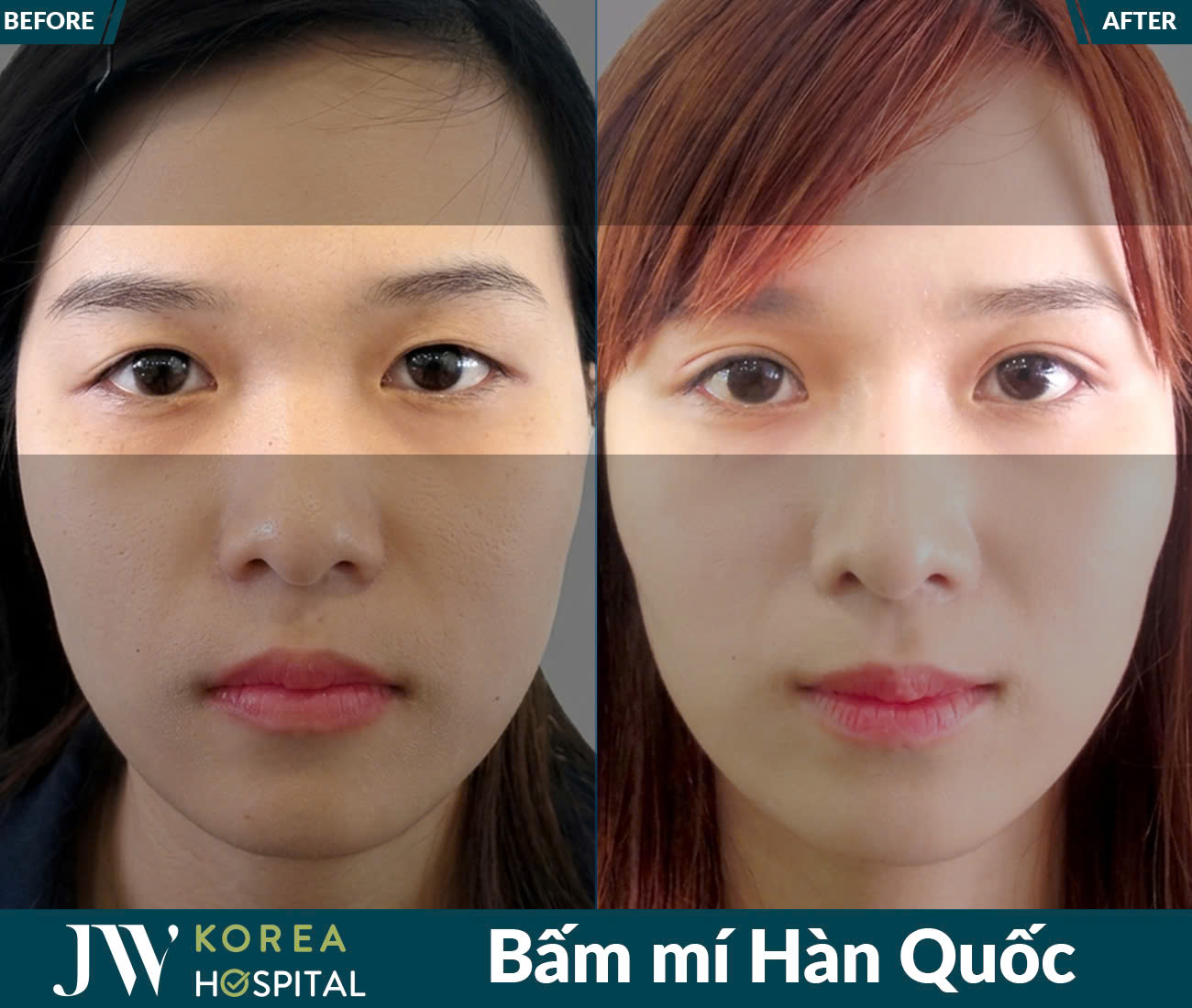 Cắt mắt/Bấm mí