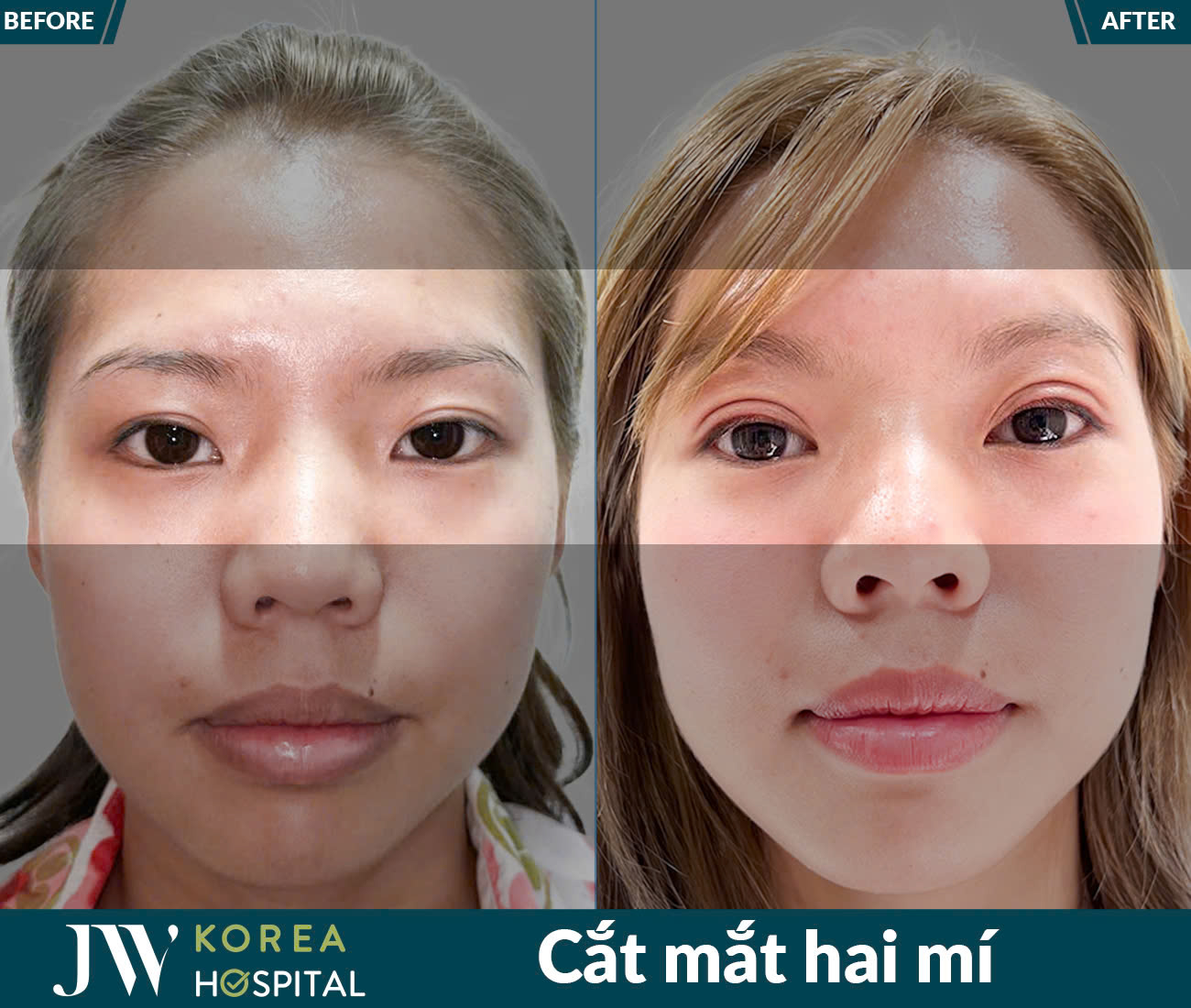 Cắt mắt/Bấm mí