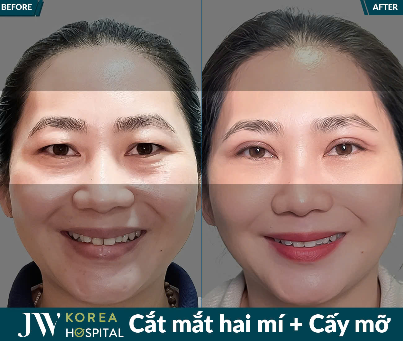 Cắt mắt/Bấm mí