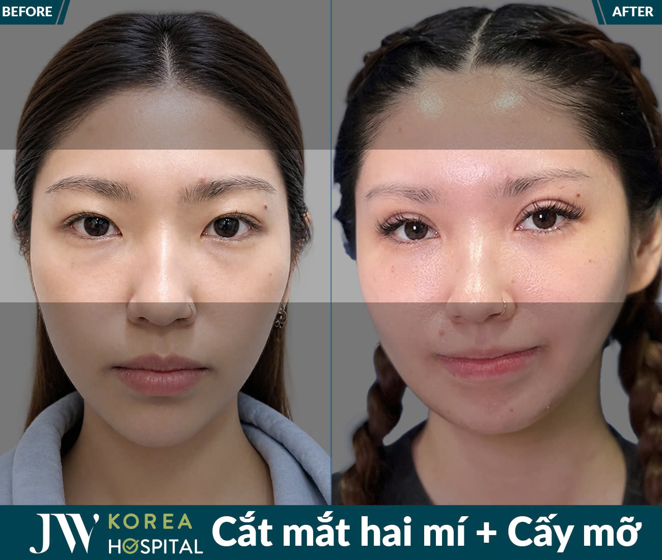 Cắt mắt/Bấm mí