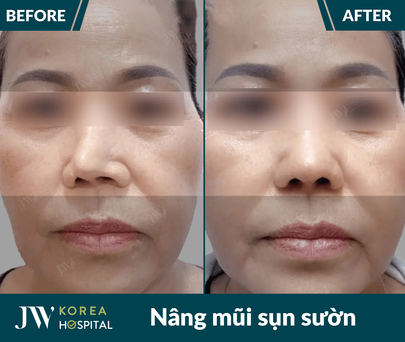 Nâng mũi sụn tự thân