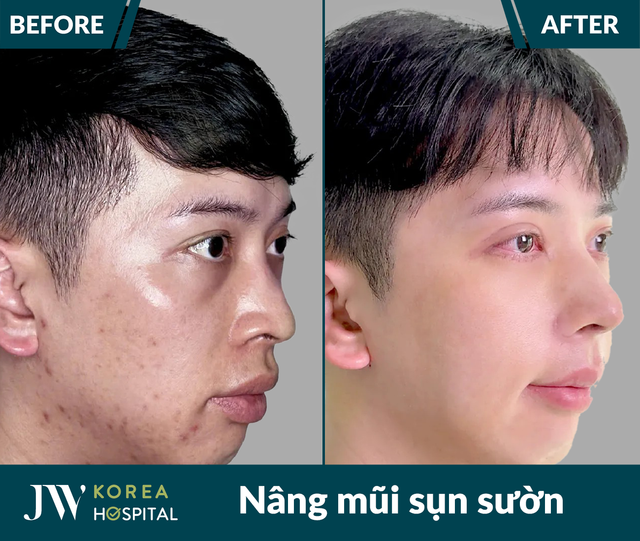 Nâng mũi sụn tự thân