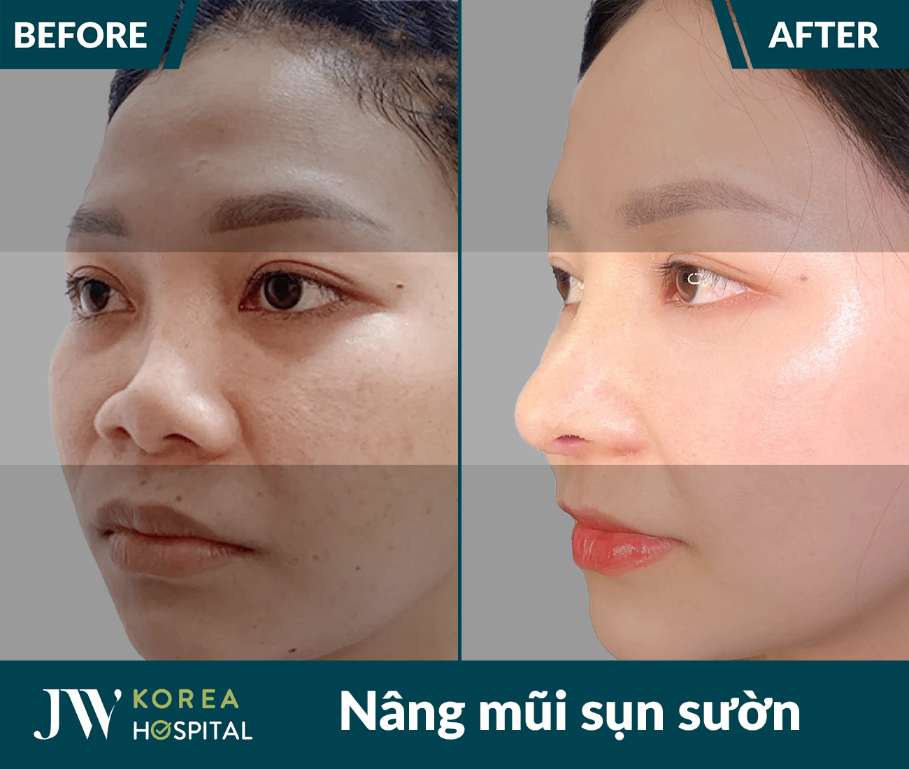 Nâng mũi sụn tự thân