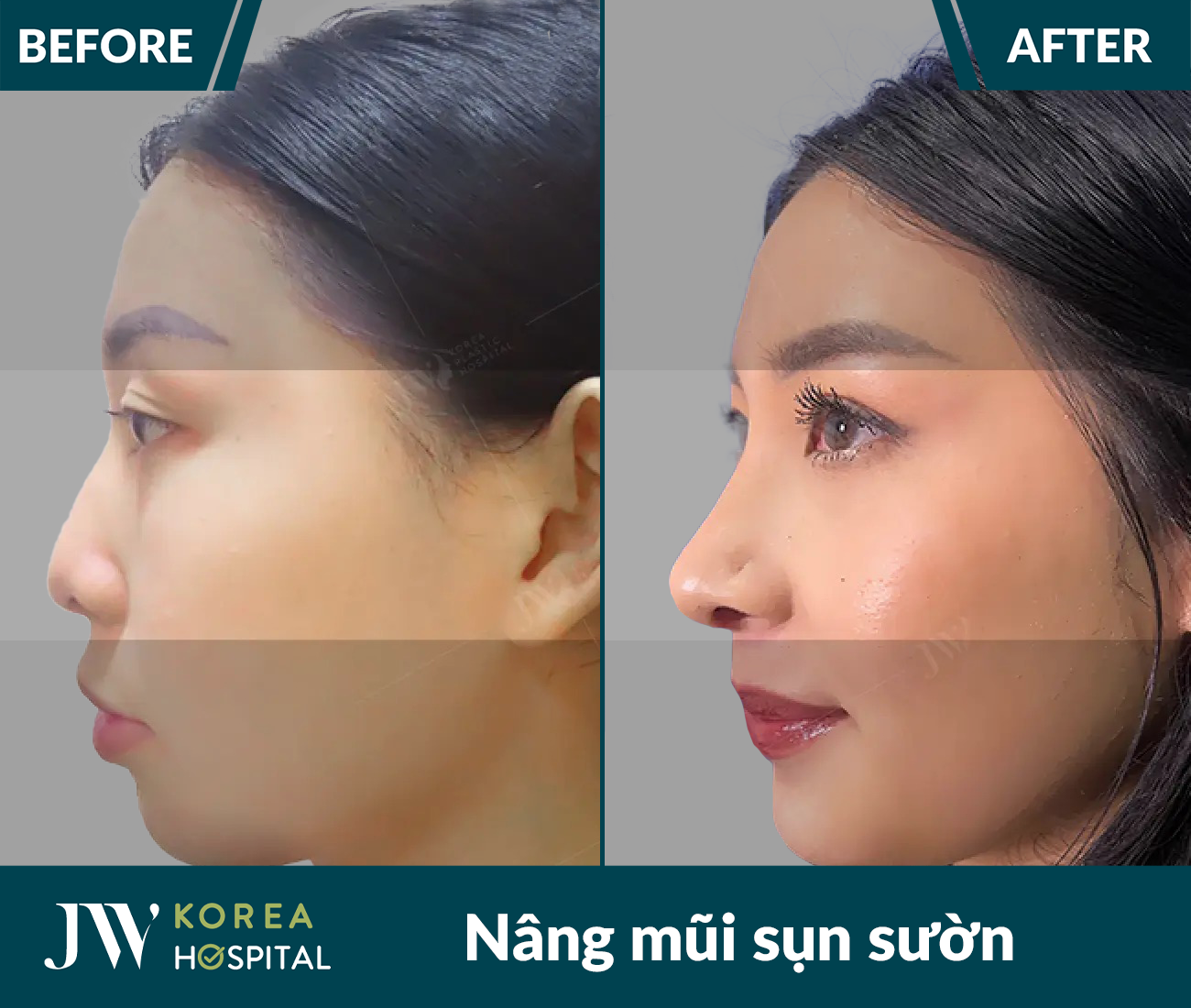 Nâng mũi sụn tự thân