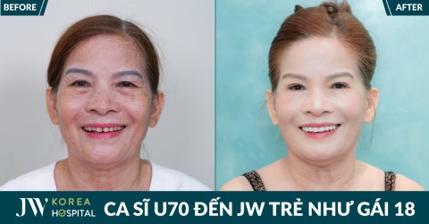 Nữ ca sĩ phòng trà 70 tuổi tìm lại vẻ tươi trẻ với Meso Baby Skin và Bọc răng sứ