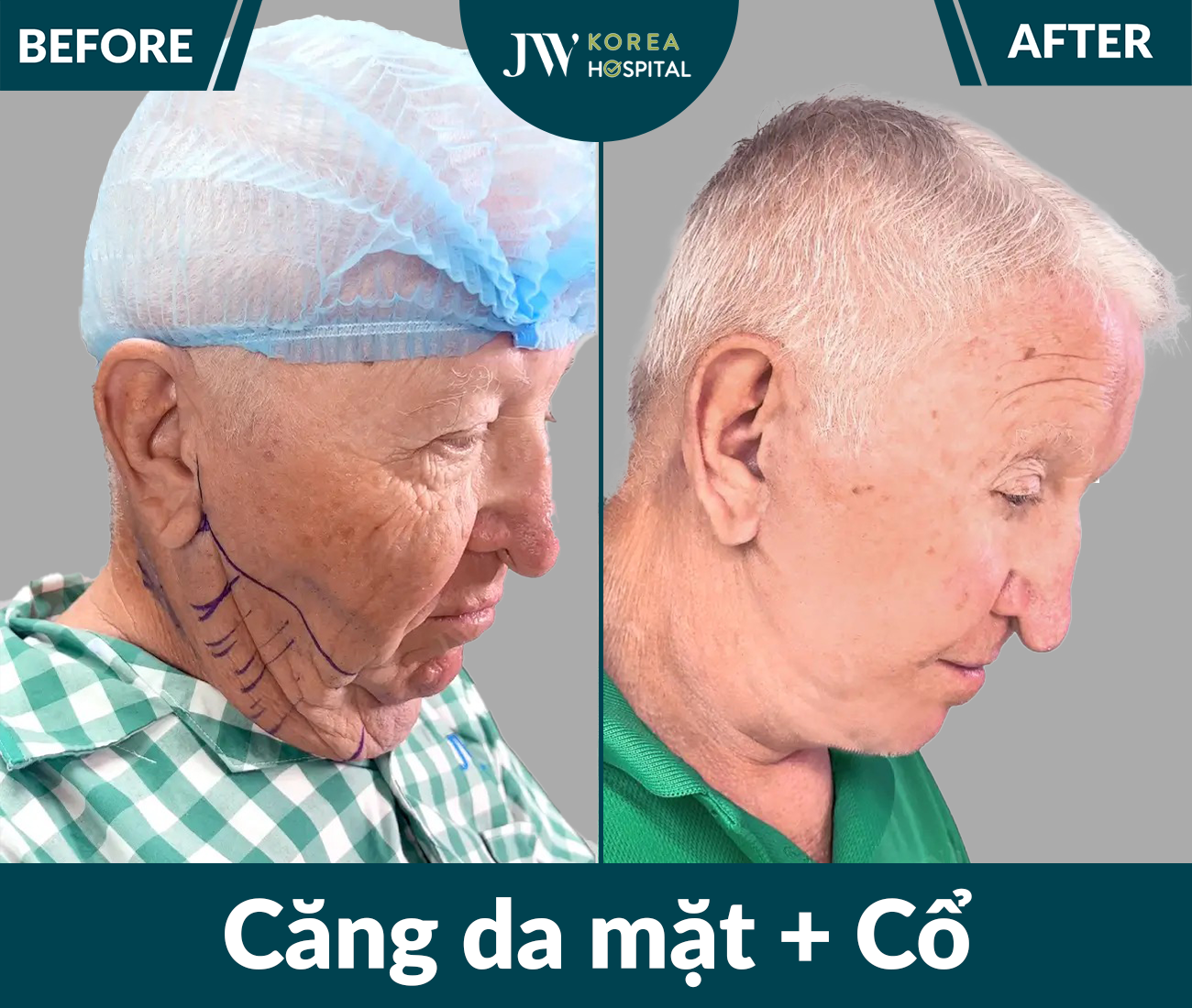 Căng da mặt SMAS PRO