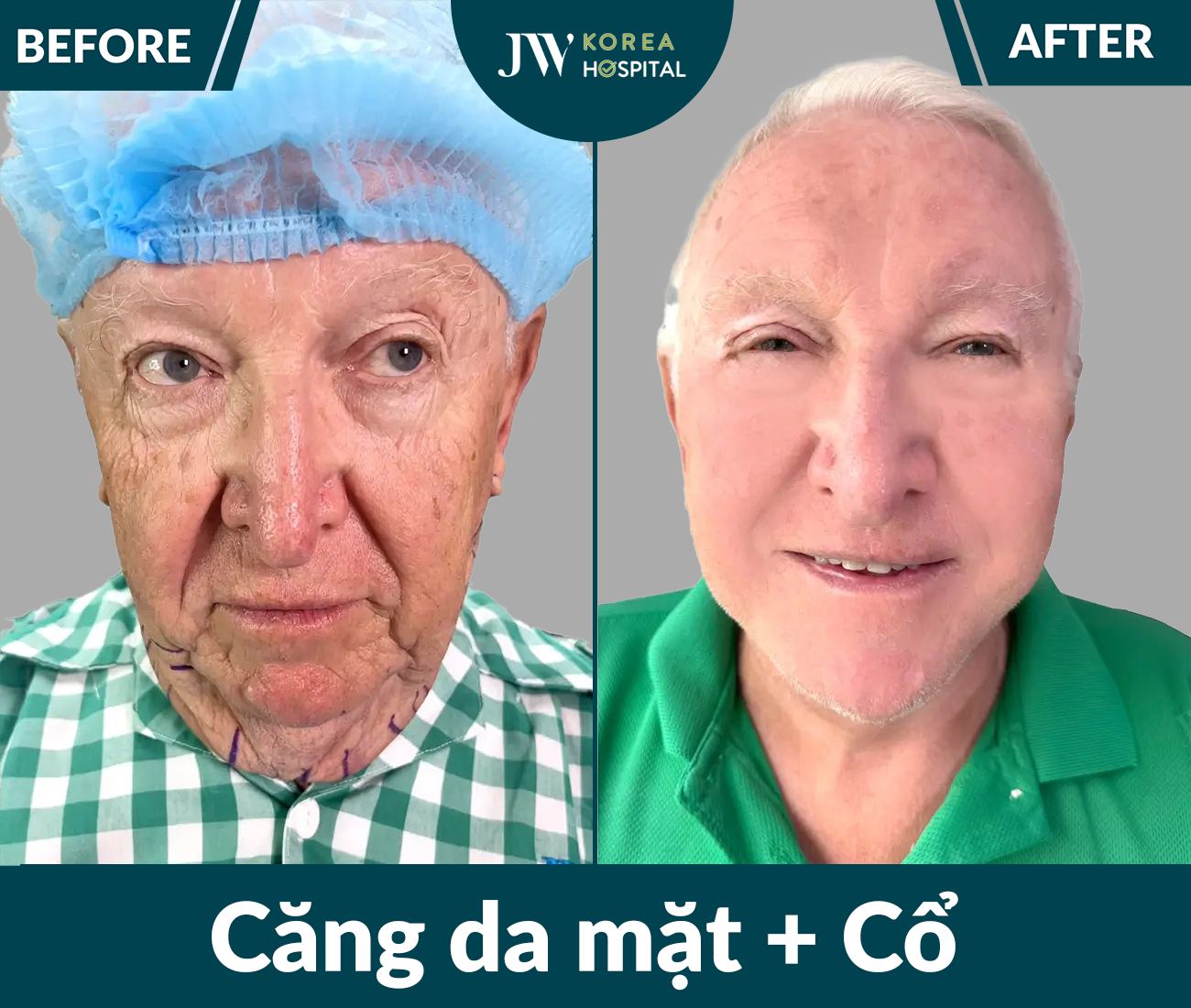 Căng da mặt SMAS PRO