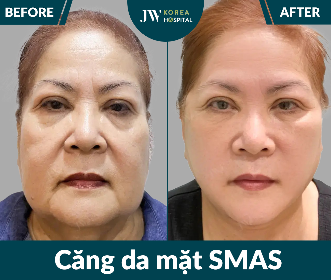 Căng da mặt SMAS PRO