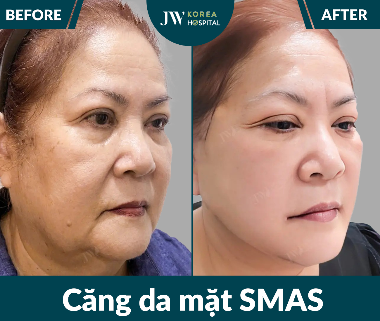 Căng da mặt SMAS PRO