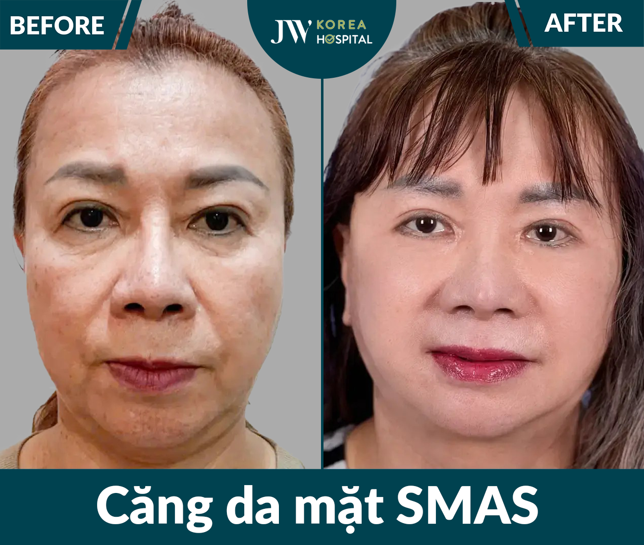 Căng da mặt SMAS PRO
