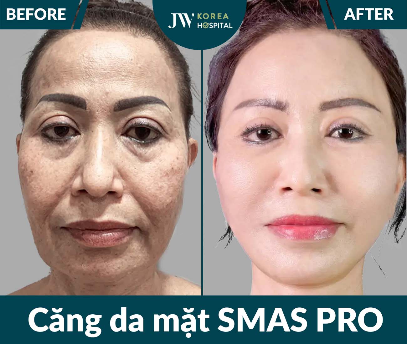 Căng da mặt SMAS PRO