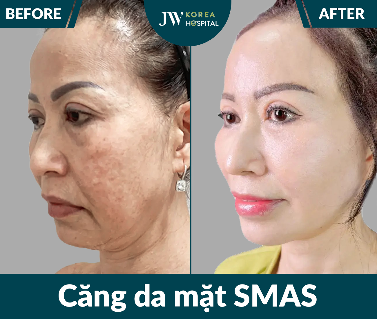 Căng da mặt SMAS PRO