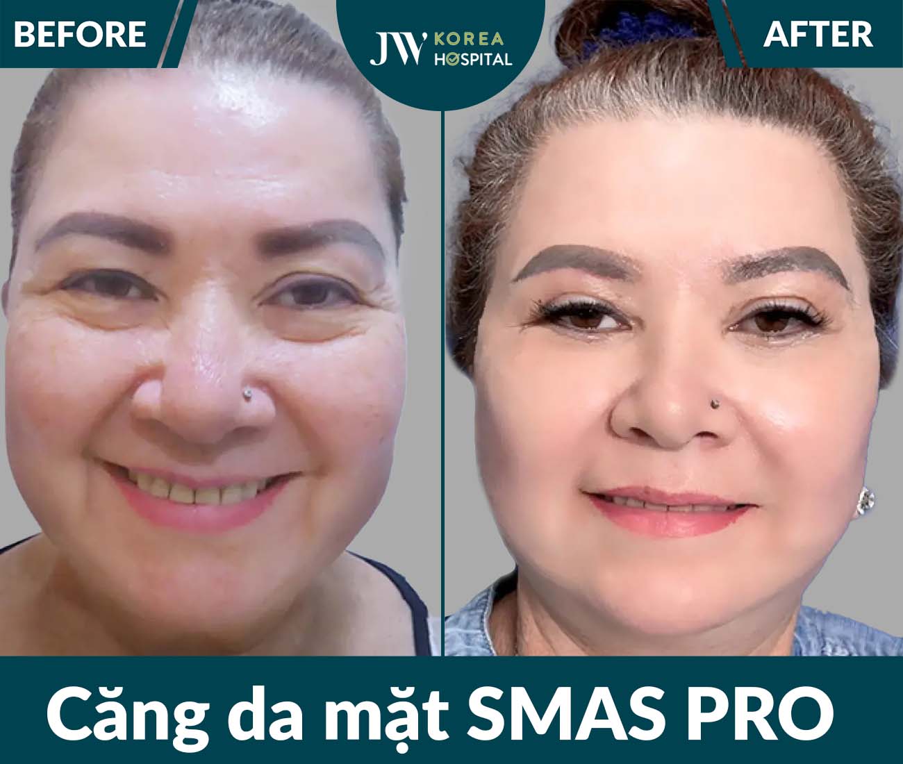 Căng da mặt SMAS PRO