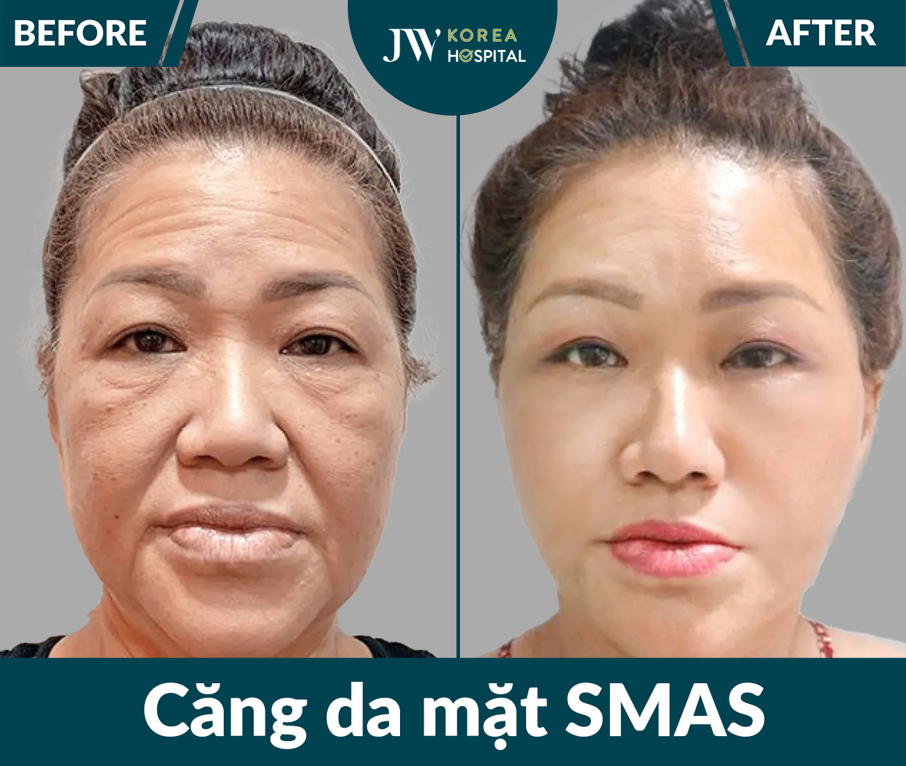 Căng da mặt SMAS PRO