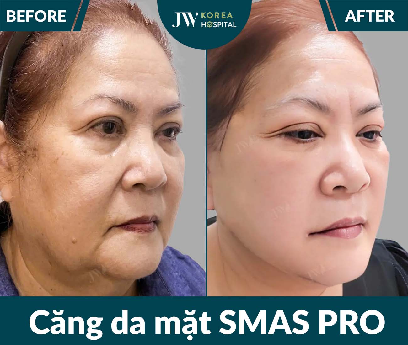 Căng da mặt SMAS PRO