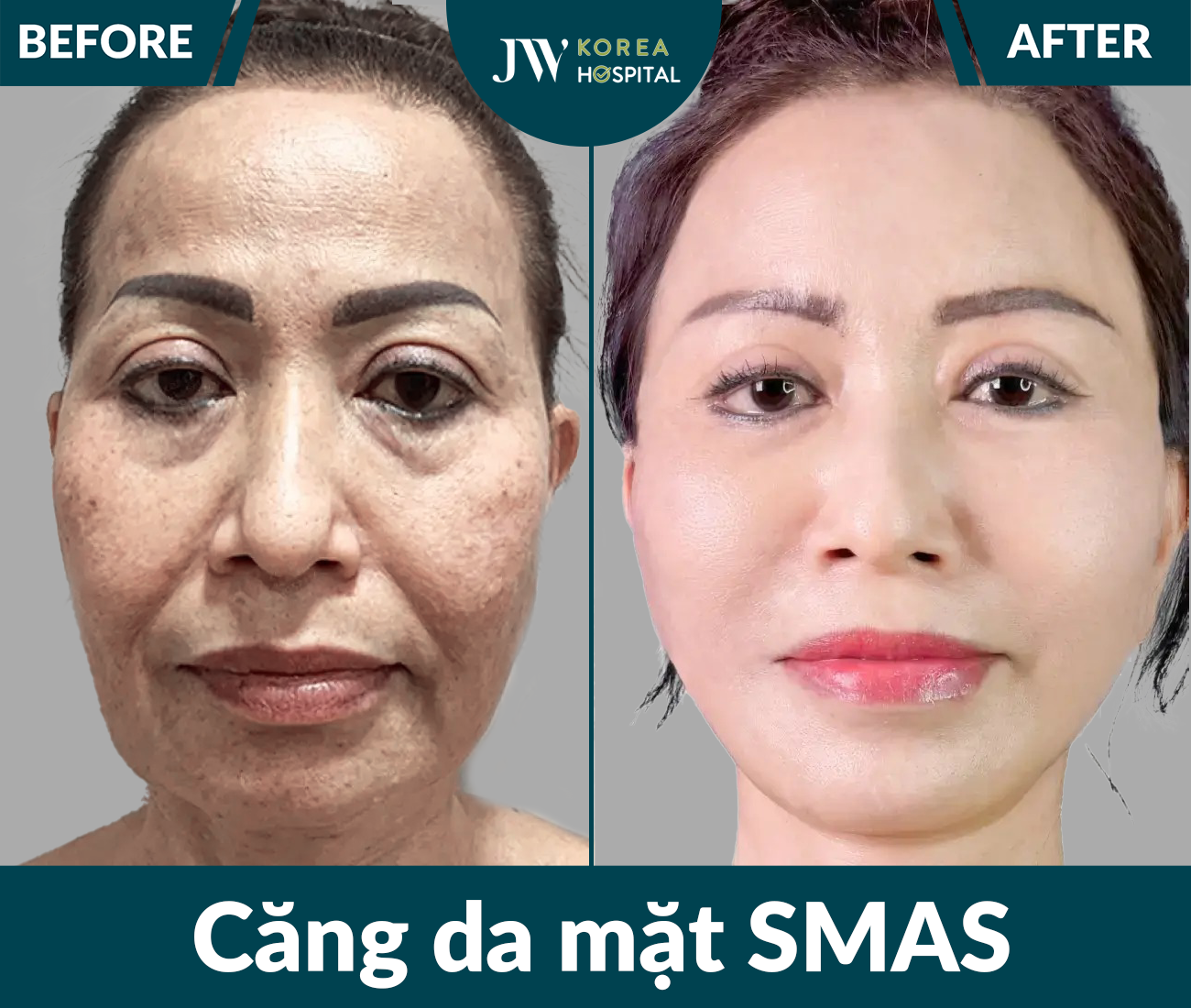 Căng da mặt SMAS PRO