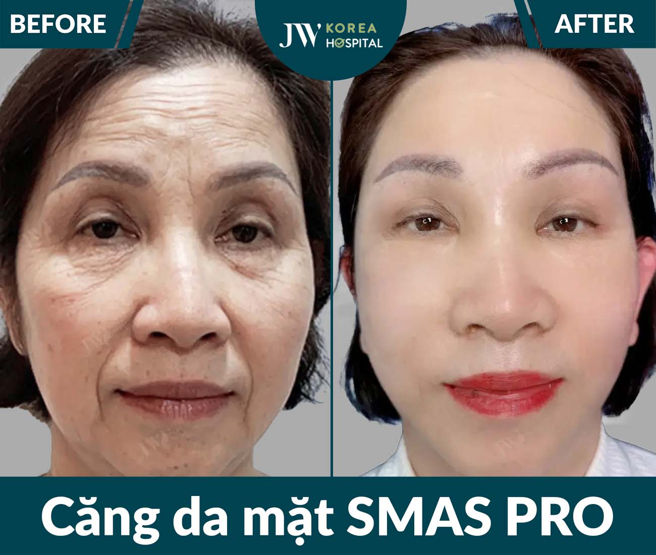 Căng da mặt SMAS PRO